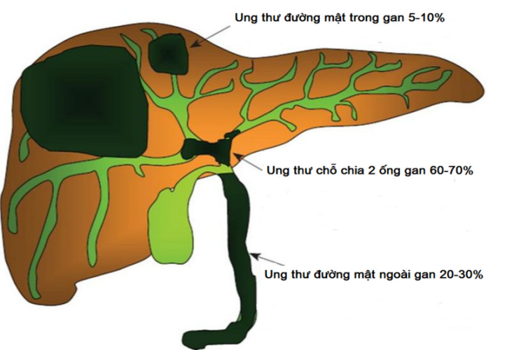Ung thư đường mật trong gan nguy hiểm đến mức nào? Có cách điều trị nào không?