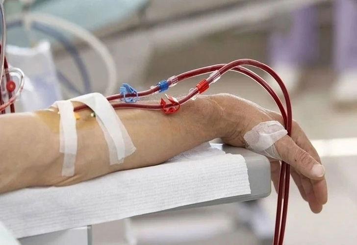 Lọc máu loại bỏ mỡ máu được không? Bộ Y tế vào cuộc