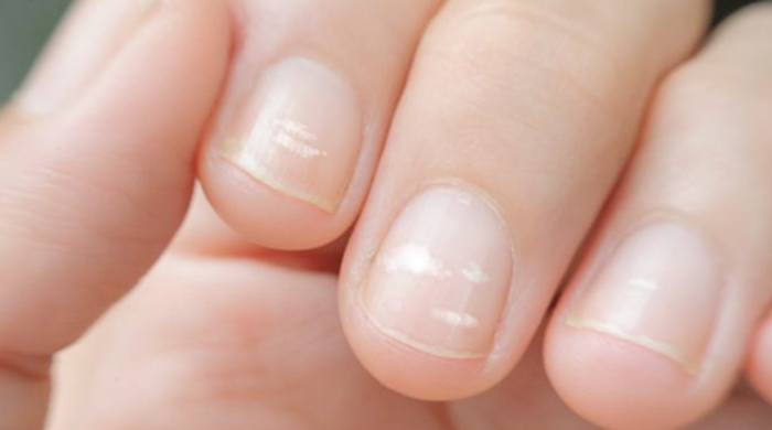 Các đốm trắng trên móng tay có phải do thiếu canxi không?