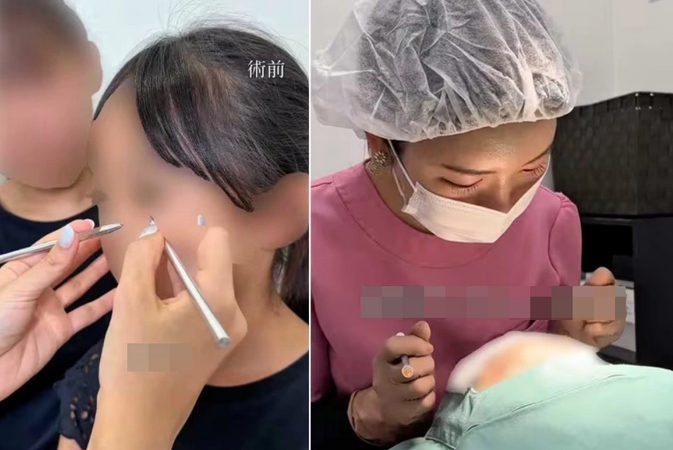 'Dao kéo' cho bé gái 10 tuổi