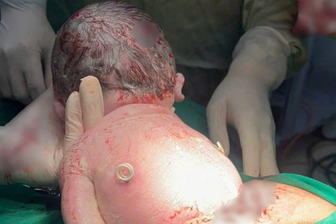 Em bé chào đời với 'đôi cánh' trên lưng