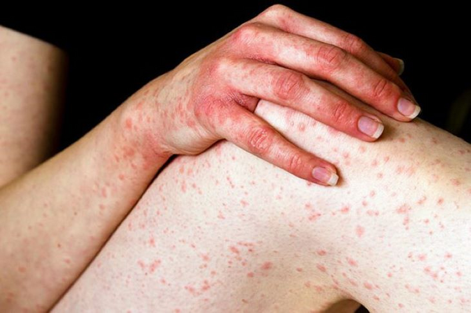 Người bị viêm da cơ địa cần lưu ý gì để tránh bùng phát trong những ngày nắng nóng?