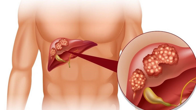 Đừng đợi vàng da mới đi khám: Đây là 8 dấu hiệu gan đang "kêu cứu"